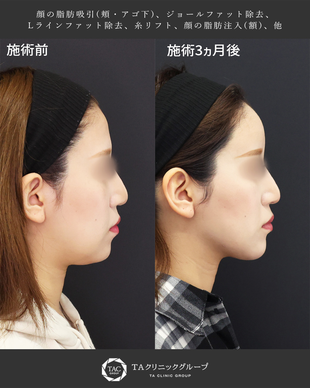 足し引きで≪映える横顔に≫二重顎を改善し、額にまるみを出す