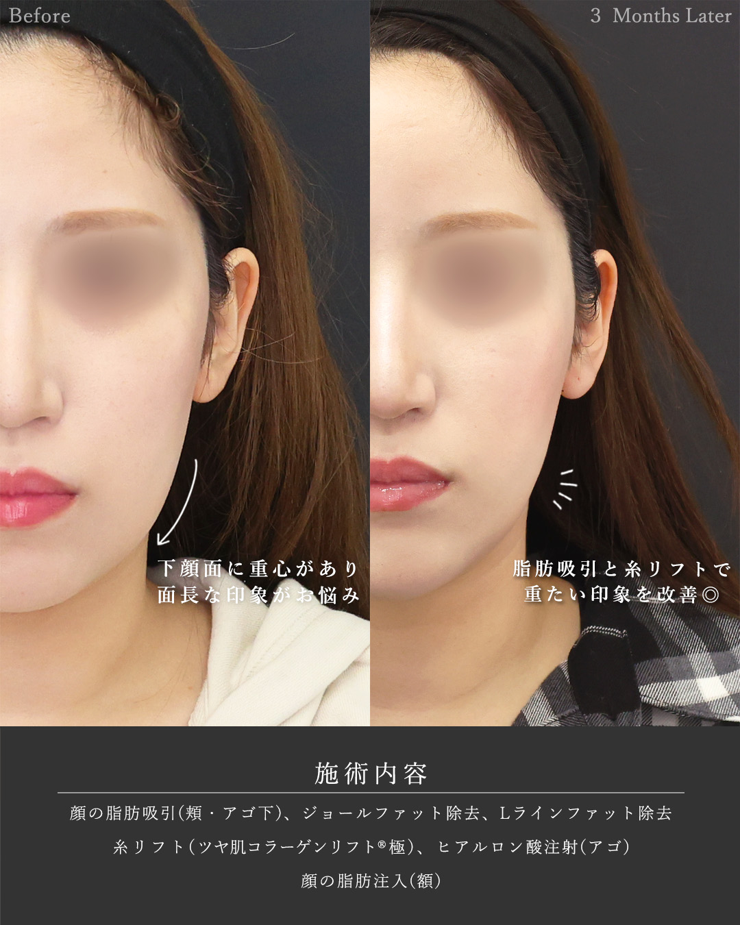 顔の脂肪吸引/おでこの脂肪注入(オルチャンデコ形成)/ジョールファット除去の症例写真 施術前後