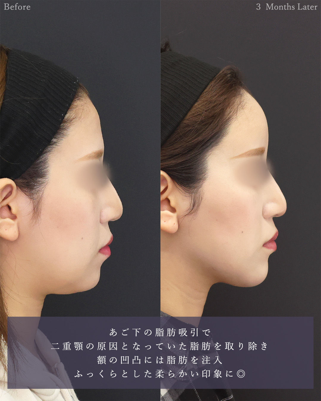 顔の脂肪吸引/おでこの脂肪注入(オルチャンデコ形成)/ジョールファット除去の症例写真 施術前後