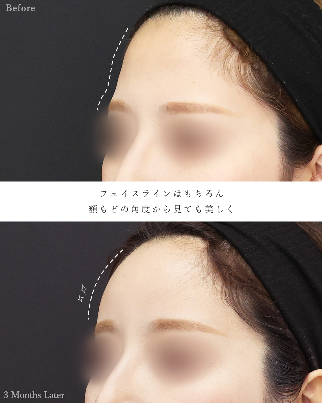 顔の脂肪吸引/おでこの脂肪注入(オルチャンデコ形成)/ジョールファット除去の症例写真 施術前後