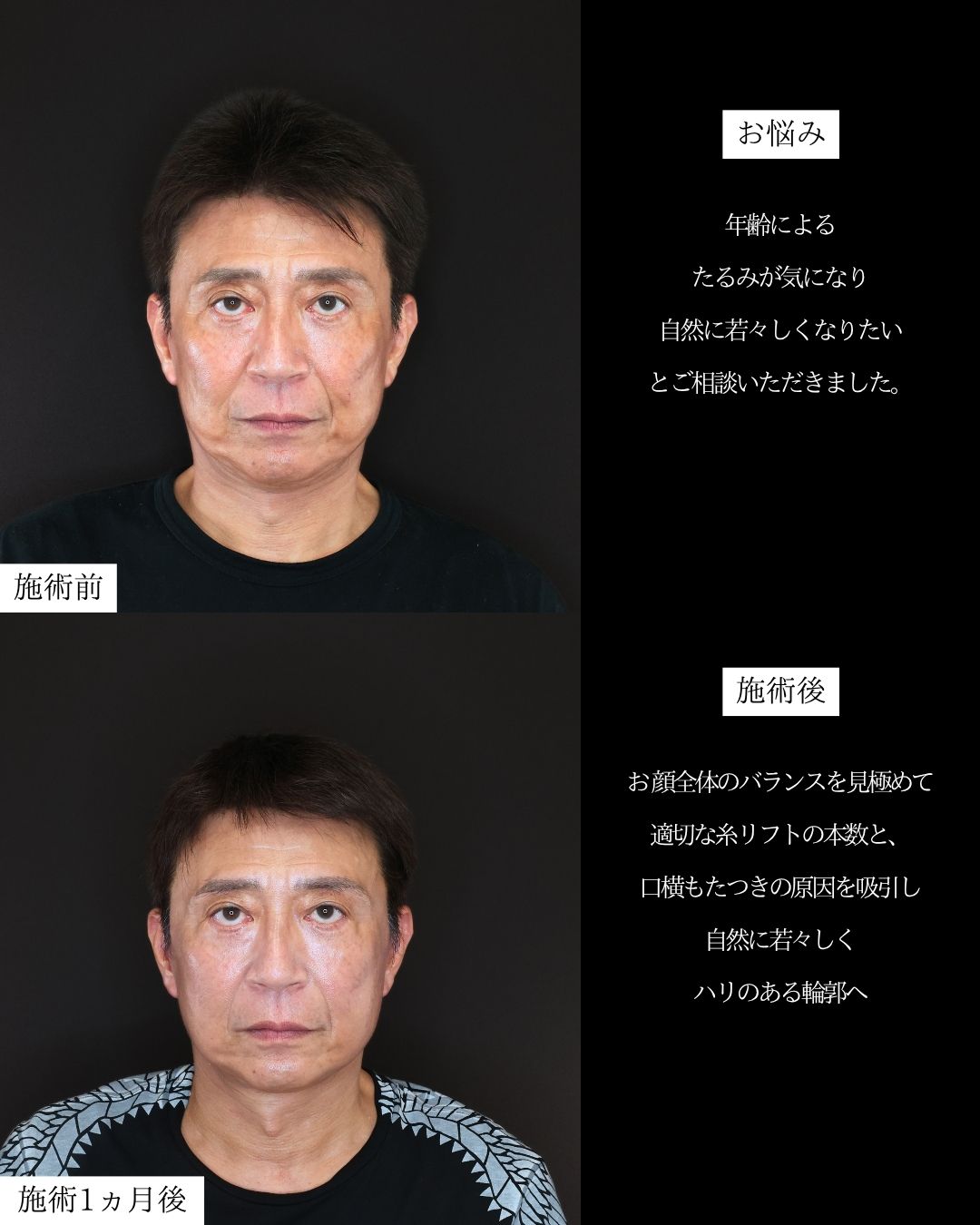 ジョールファット除去/顔の脂肪吸引/TAC式 ツヤ肌コラーゲンリフト®の症例写真 施術前後 