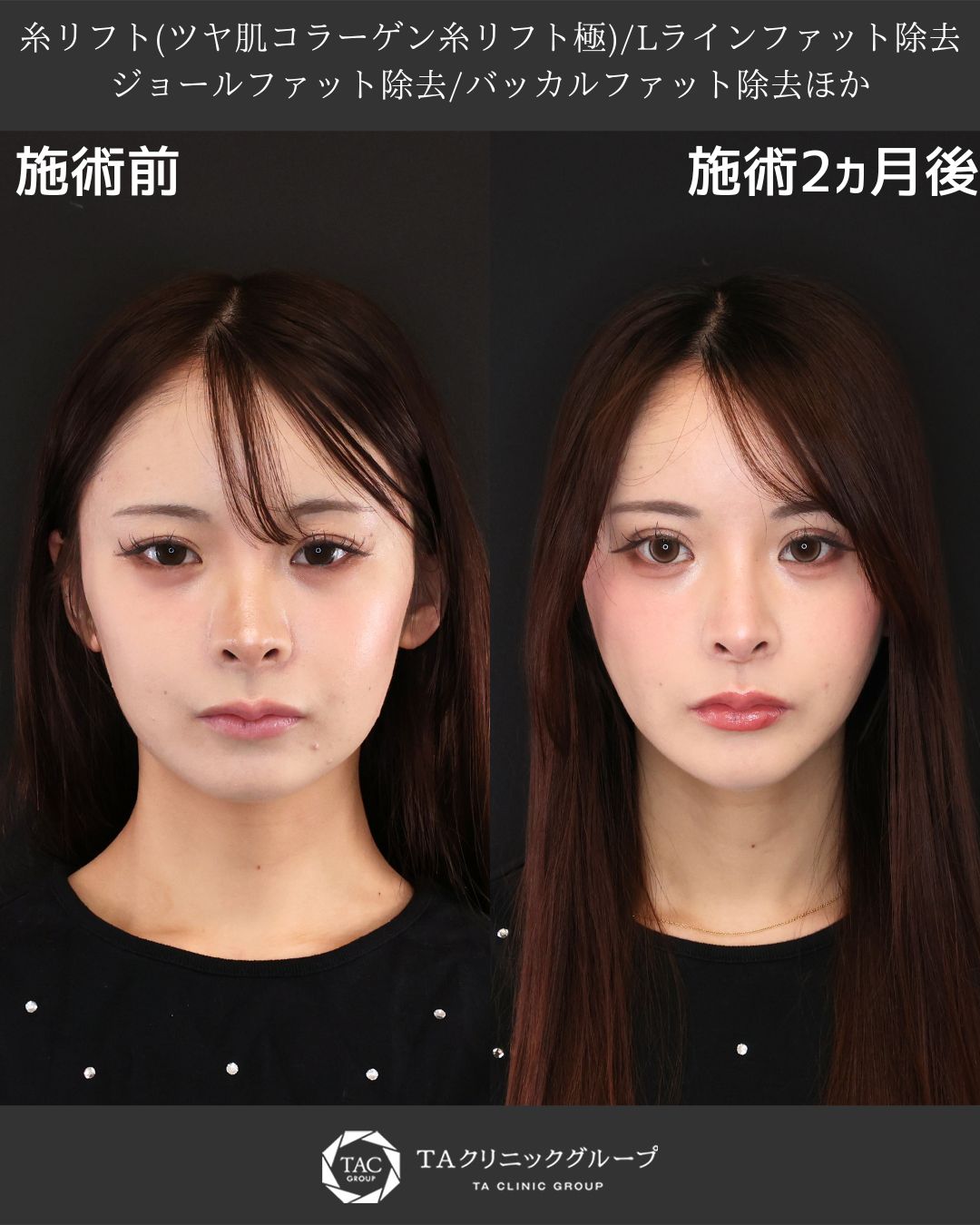 理想の卵型フェイスへ。下顔面をすっきりアップデート