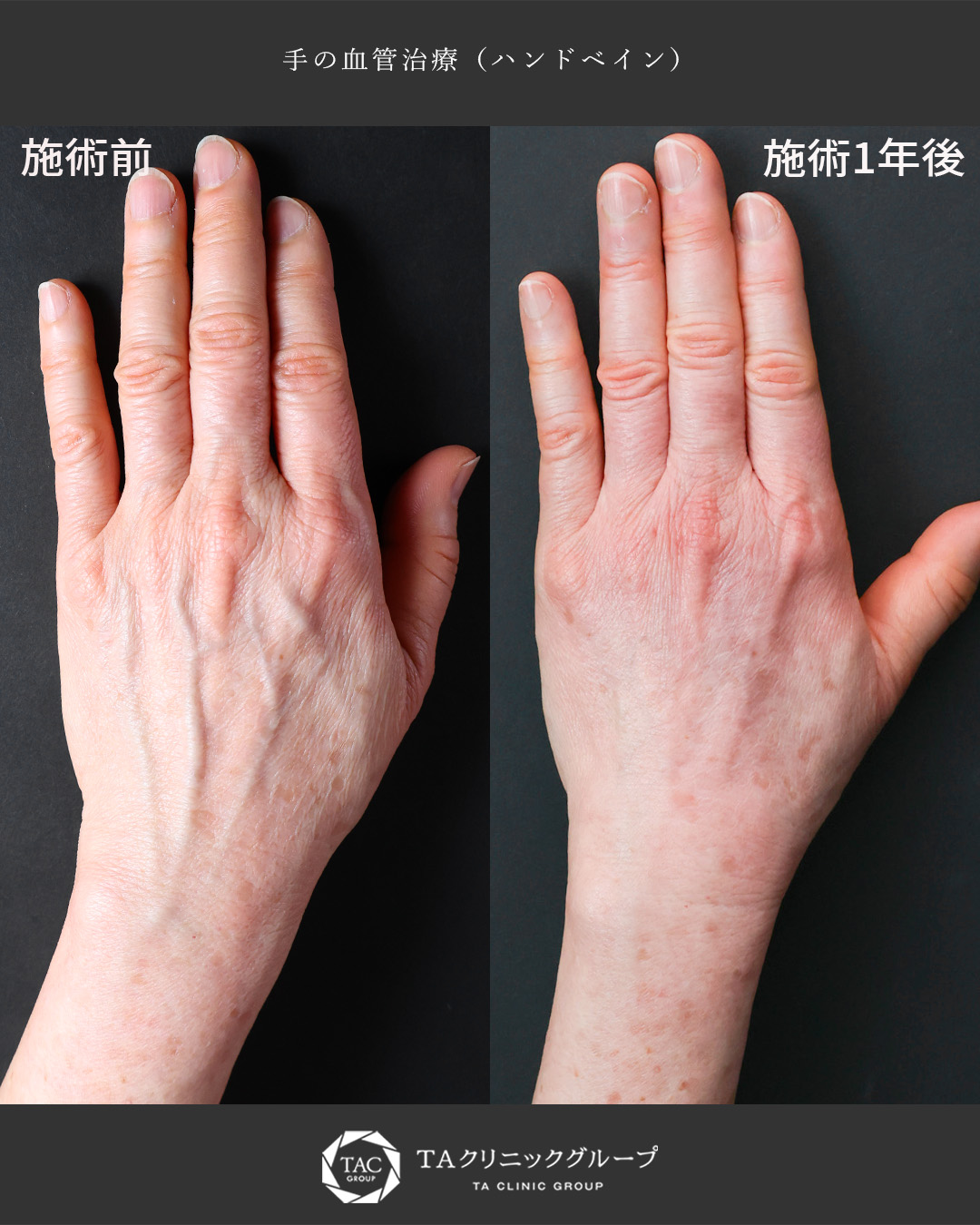 手の血管治療(ハンドベイン)の症例写真 施術前後