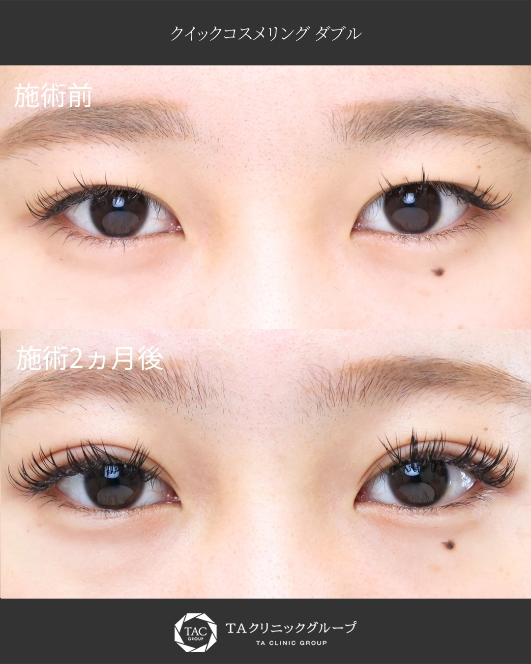 【二重埋没】裏留め｜糸玉が表側に来ないからばれにくい◎