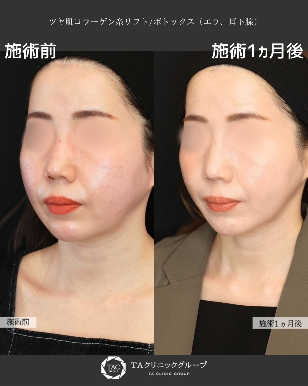 切らずにリフトアップ。ツヤと引き締まりを両立した40代女性症例