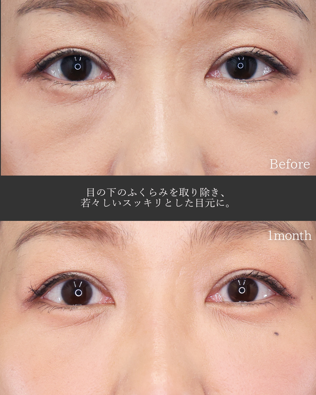 下眼瞼脱脂術（目の下のたるみ取り・目の下の脂肪ふくらみ取り）/目の下のヒアルロン酸注射/ゴルゴ線のヒアルロン酸注射の症例写真 施術前後 