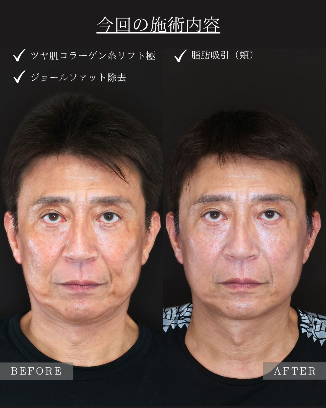 ジョールファット除去/顔の脂肪吸引/TAC式 ツヤ肌コラーゲンリフト®の症例写真 施術前後 