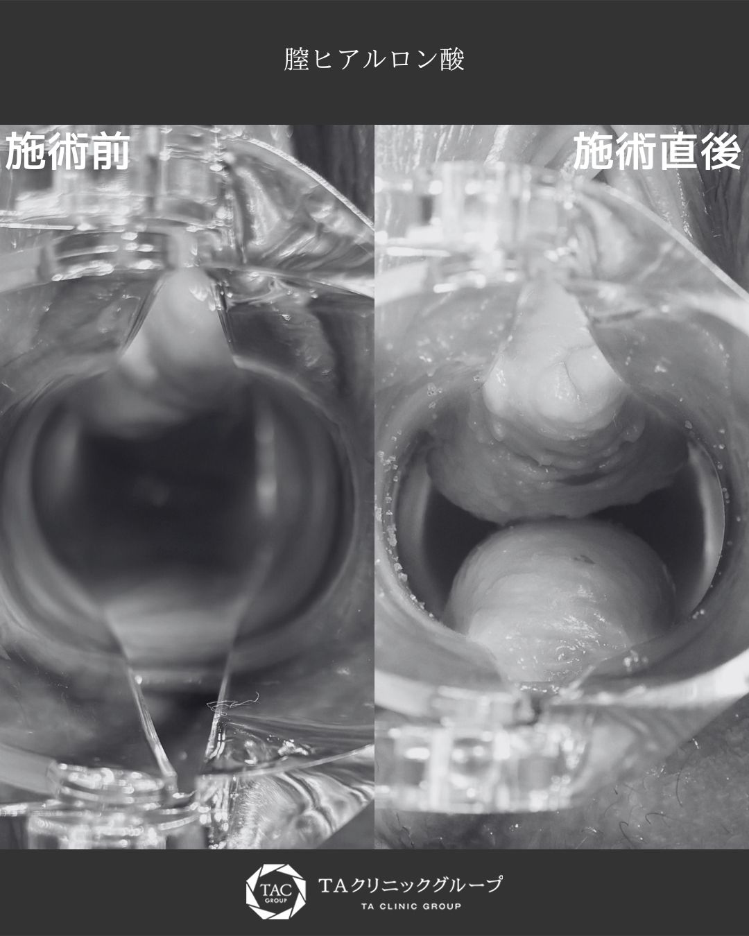 膣ヒアルロン酸注入でうるおいとハリを取り戻す