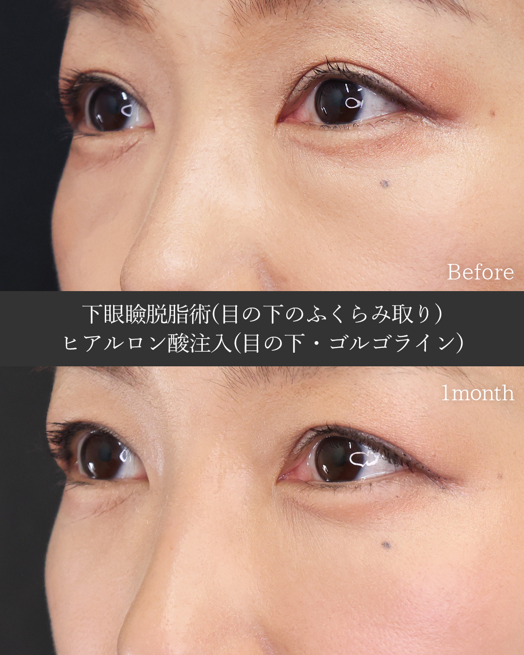 下眼瞼脱脂術（目の下のたるみ取り・目の下の脂肪ふくらみ取り）/目の下のヒアルロン酸注射/ゴルゴ線のヒアルロン酸注射の症例写真 施術前後 