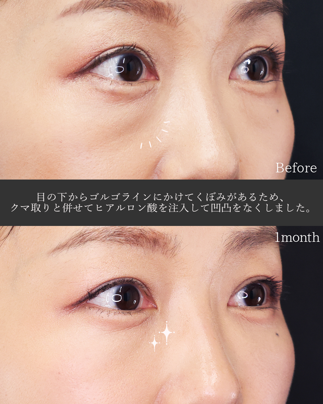 下眼瞼脱脂術（目の下のたるみ取り・目の下の脂肪ふくらみ取り）/目の下のヒアルロン酸注射/ゴルゴ線のヒアルロン酸注射の症例写真 施術前後 