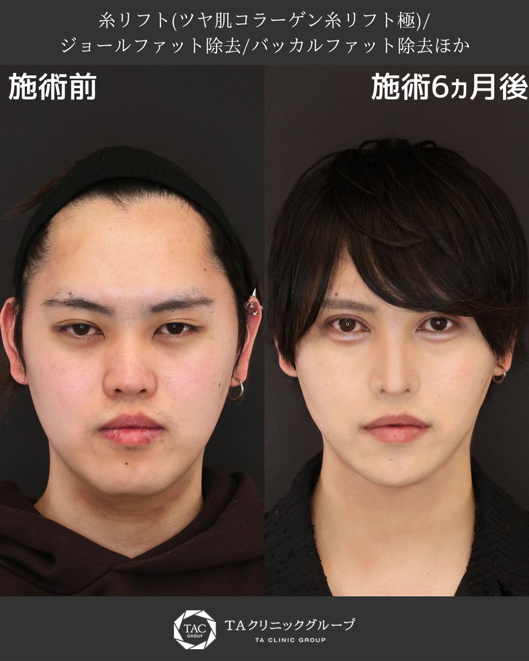 糸リフト×脂肪除去で理想の小顔ラインに