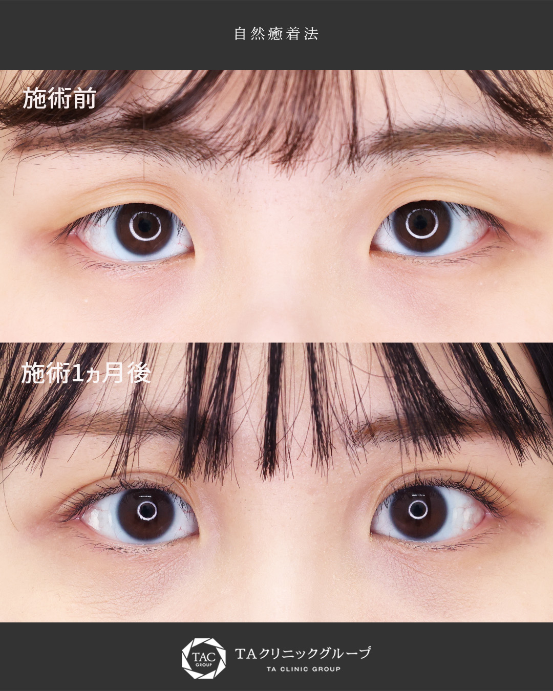 【アイプチ卒業】自然癒着法で念願の二重に！