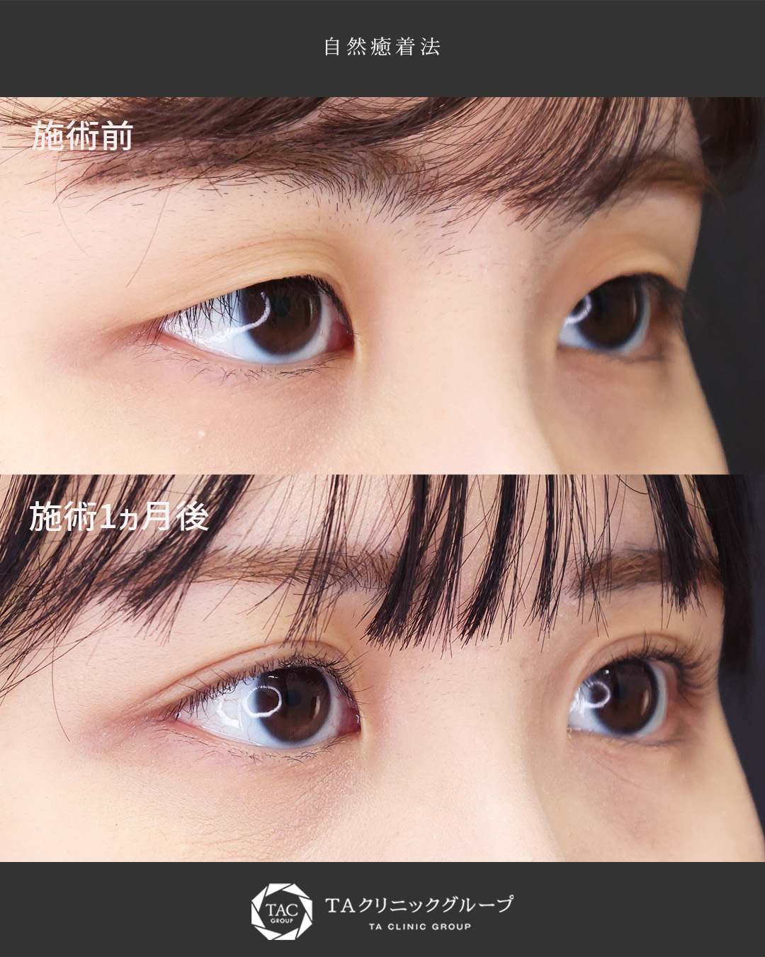 自然癒着法の症例写真 施術前後 