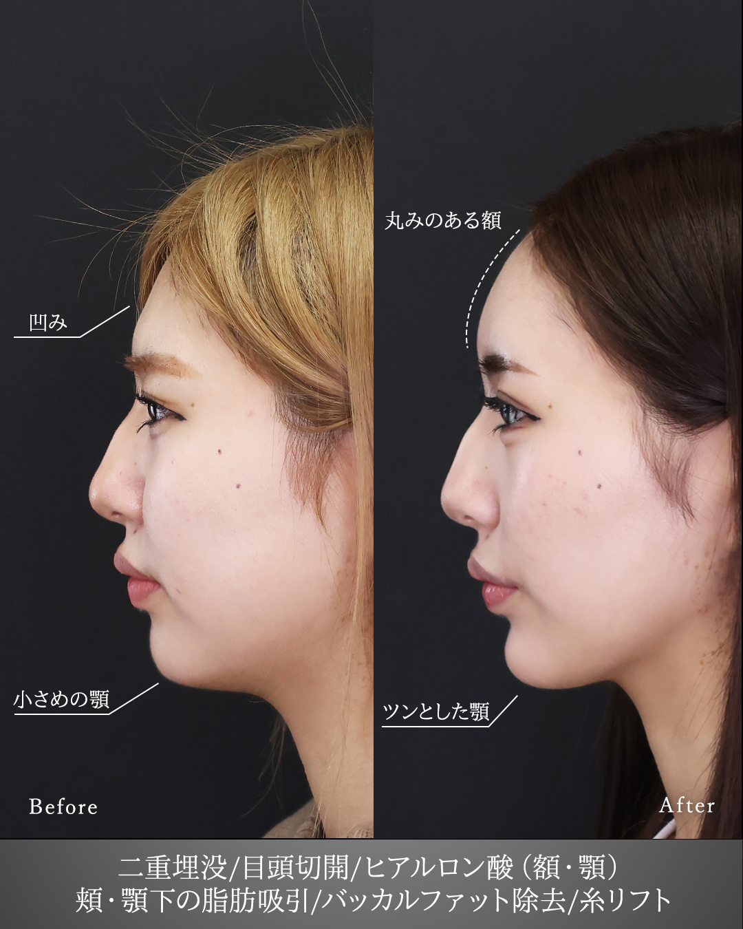 二重埋没法/目頭切開術/顔の脂肪吸引の症例写真 施術前後 