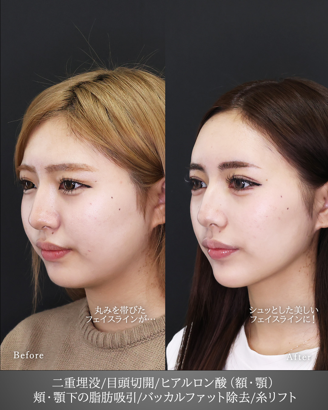 二重埋没法/目頭切開術/顔の脂肪吸引の症例写真 施術前後 