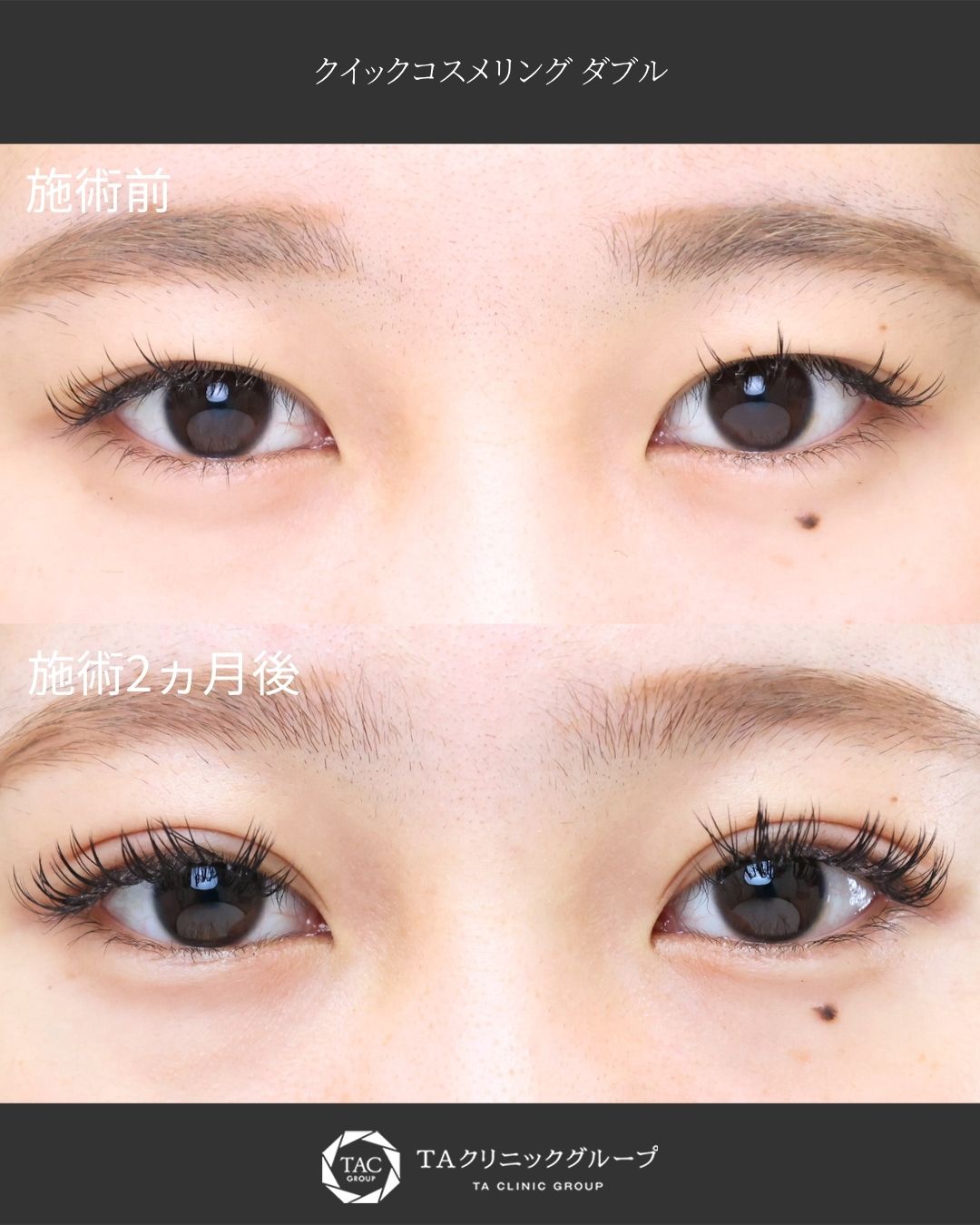 【二重埋没】裏留め｜糸玉が表側に来ないからばれにくい◎