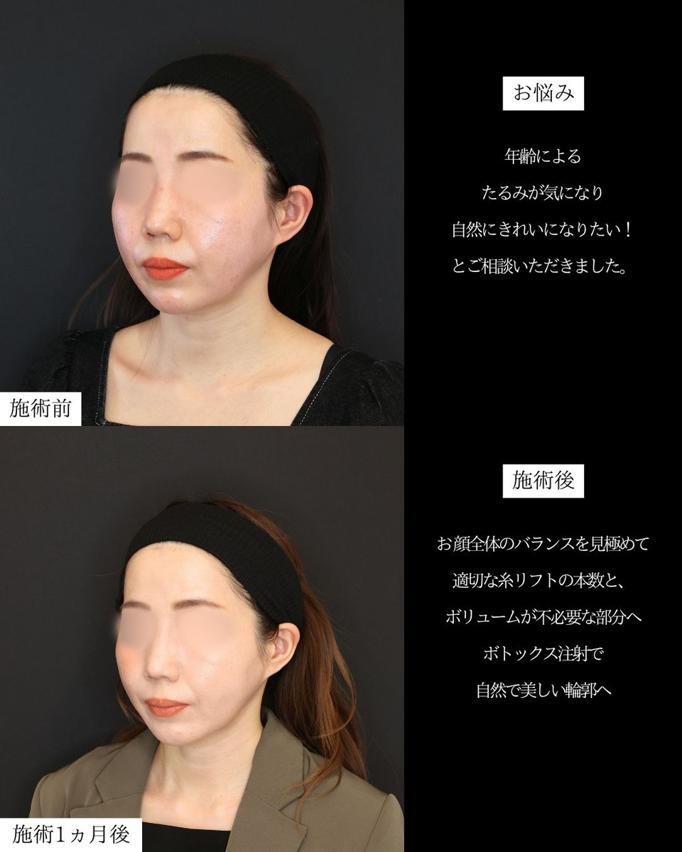 TAC式 ツヤ肌コラーゲンリフト®/ボトックス注射：その他/エラボトックス注射の症例写真 施術前後 