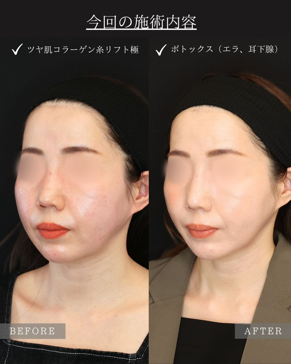 TAC式 ツヤ肌コラーゲンリフト®/ボトックス注射：その他/エラボトックス注射の症例写真 施術前後 