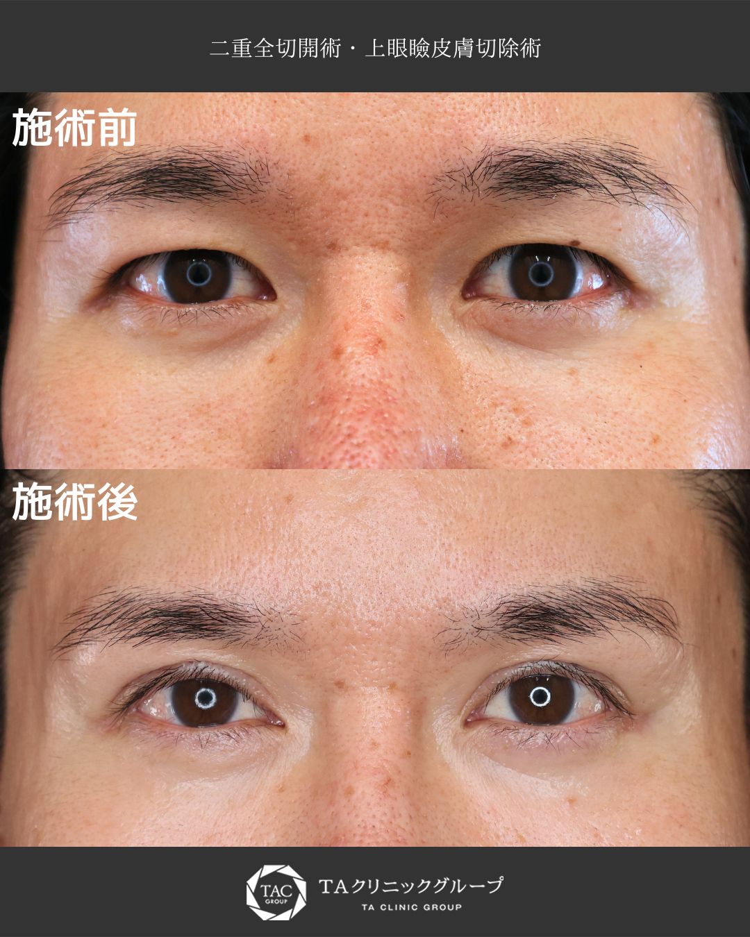 目元の重たさを解消し、自然な二重へ