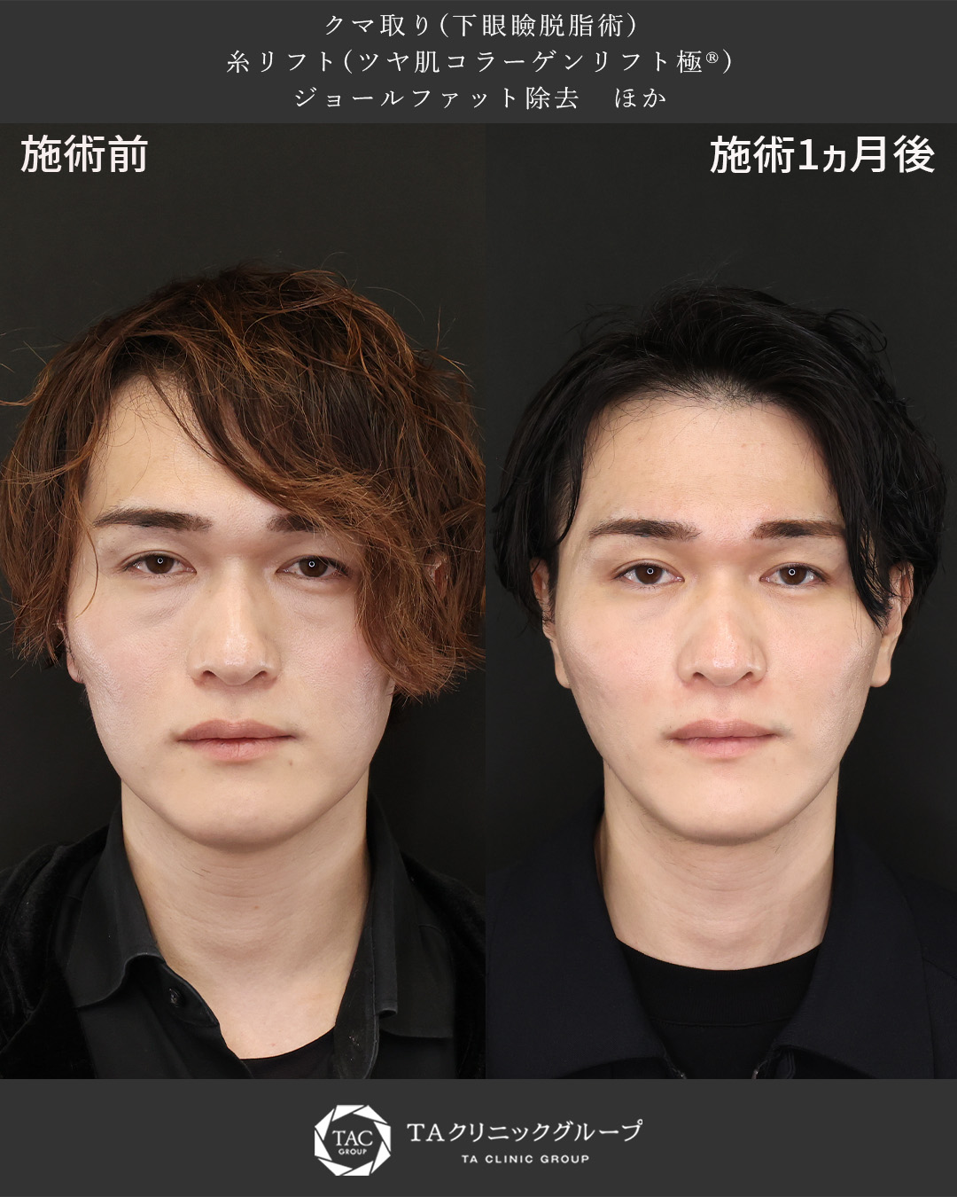 30代男性｜クマ取りと糸リフトで疲れ顔改善＆整形感なく爽やかな印象に