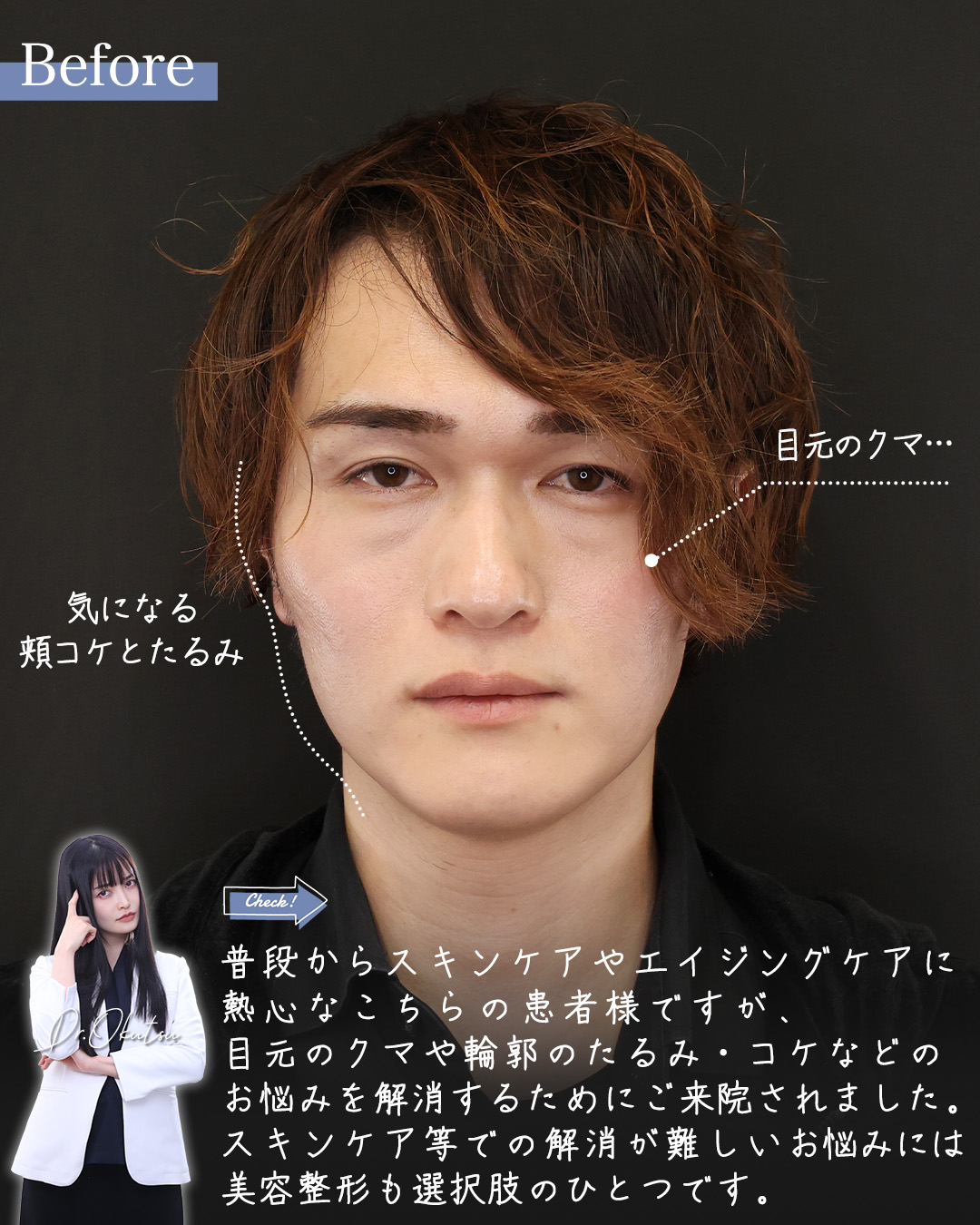 TAC式 ツヤ肌コラーゲンリフト®/ジョールファット除去/下眼瞼脱脂術（目の下のたるみ取り・目の下の脂肪ふくらみ取り）の症例写真 施術前後 