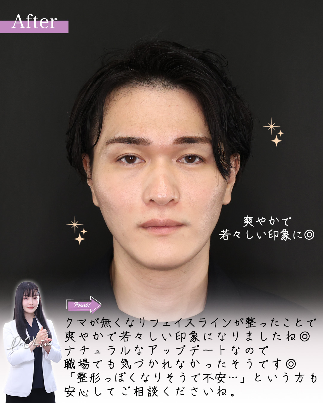 TAC式 ツヤ肌コラーゲンリフト®/ジョールファット除去/下眼瞼脱脂術（目の下のたるみ取り・目の下の脂肪ふくらみ取り）の症例写真 施術前後 