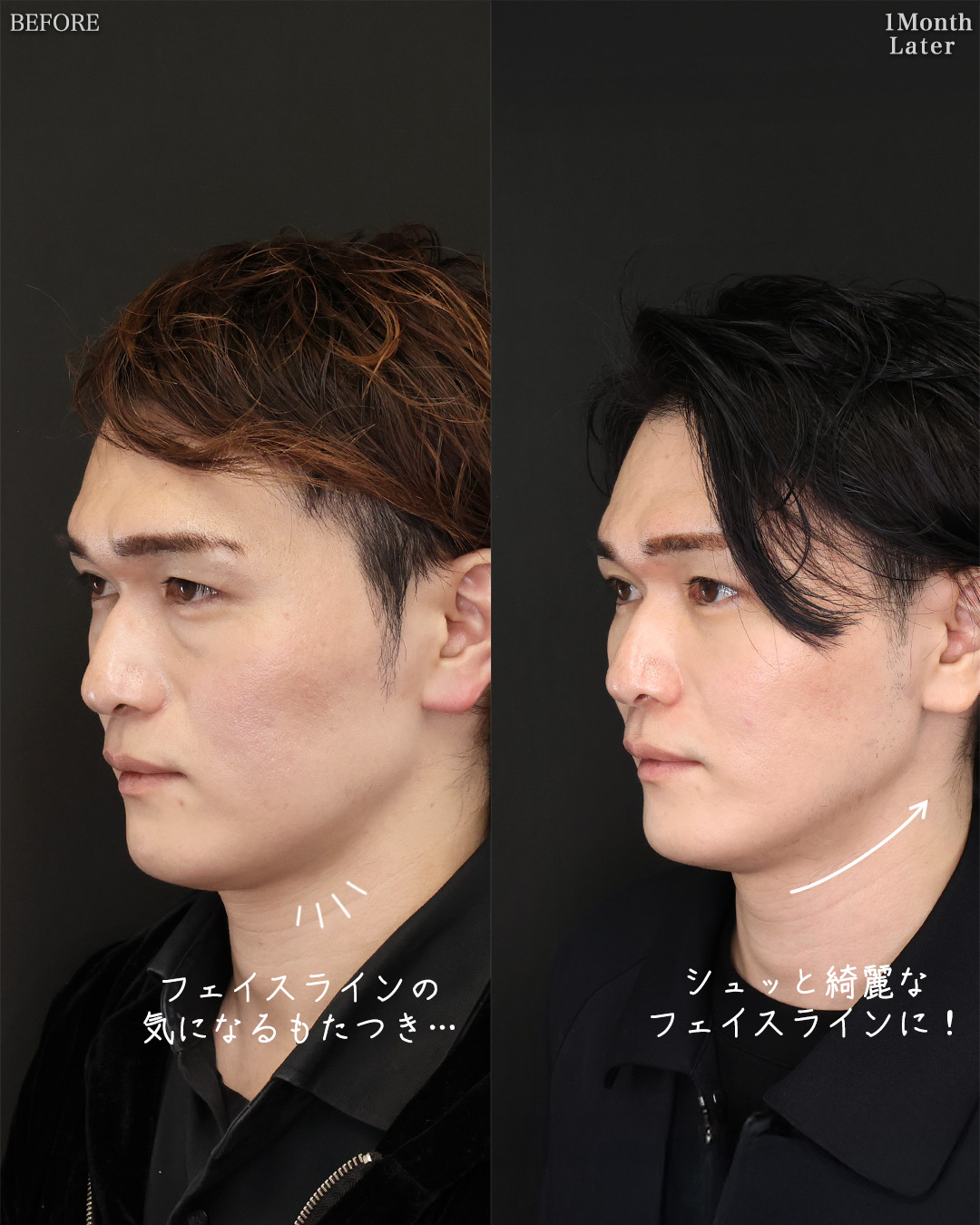 TAC式 ツヤ肌コラーゲンリフト®/ジョールファット除去/下眼瞼脱脂術（目の下のたるみ取り・目の下の脂肪ふくらみ取り）の症例写真 施術前後 