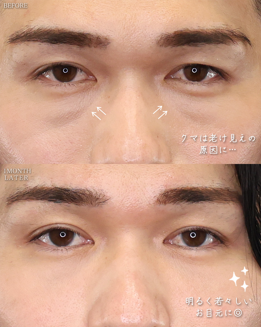 TAC式 ツヤ肌コラーゲンリフト®/ジョールファット除去/下眼瞼脱脂術（目の下のたるみ取り・目の下の脂肪ふくらみ取り）の症例写真 施術前後 