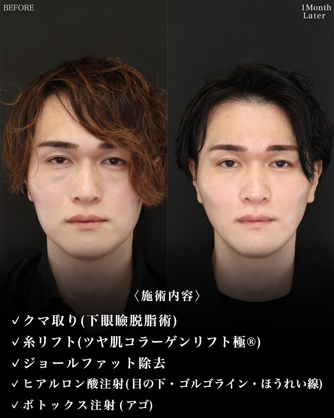 TAC式 ツヤ肌コラーゲンリフト®/ジョールファット除去/下眼瞼脱脂術（目の下のたるみ取り・目の下の脂肪ふくらみ取り）の症例写真 施術前後 