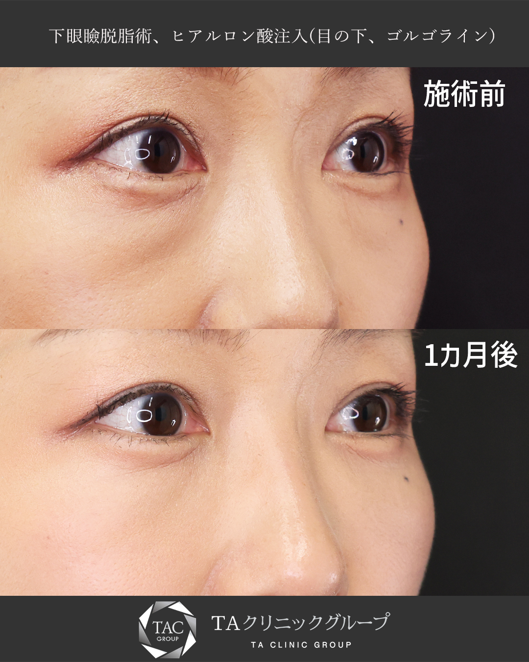 【クマ取り×ヒアルロン酸】ふくらみを無くして若々しいお目元に！