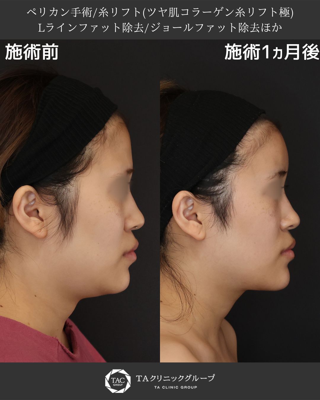 ペリカン手術＋糸リフトで二重アゴ・たるみを改善