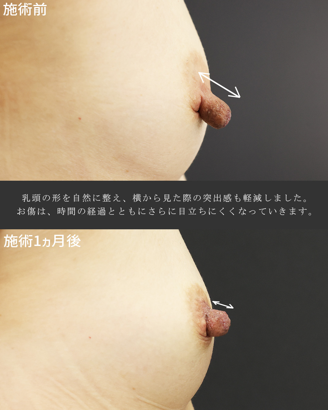 乳頭縮小術の症例写真 施術前後 
