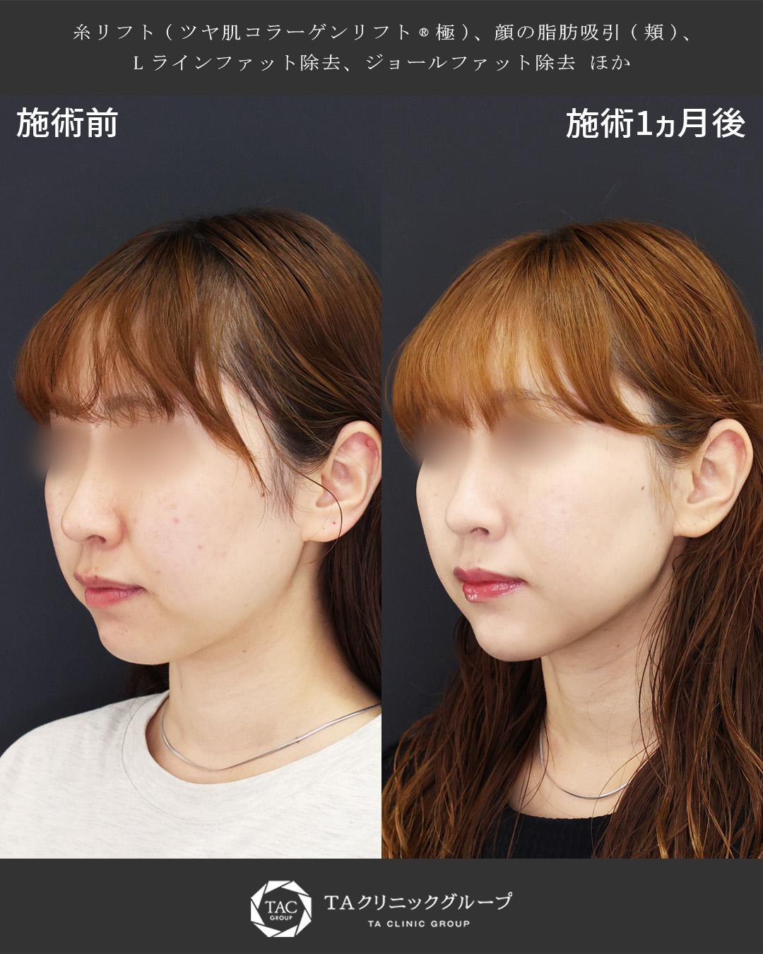 可愛い子はこっそりやってる?垢抜け小顔術