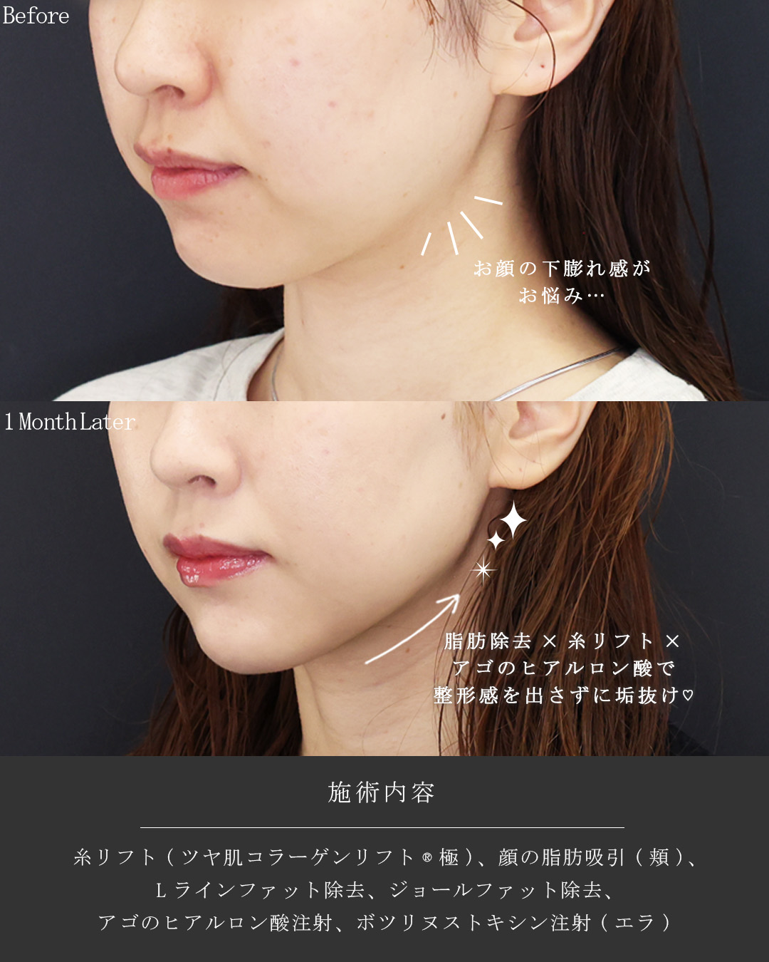 TAC式 ツヤ肌コラーゲンリフト®/Lラインファット除去（エラ下脂肪除去）/ジョールファット除去の症例写真 施術前後 