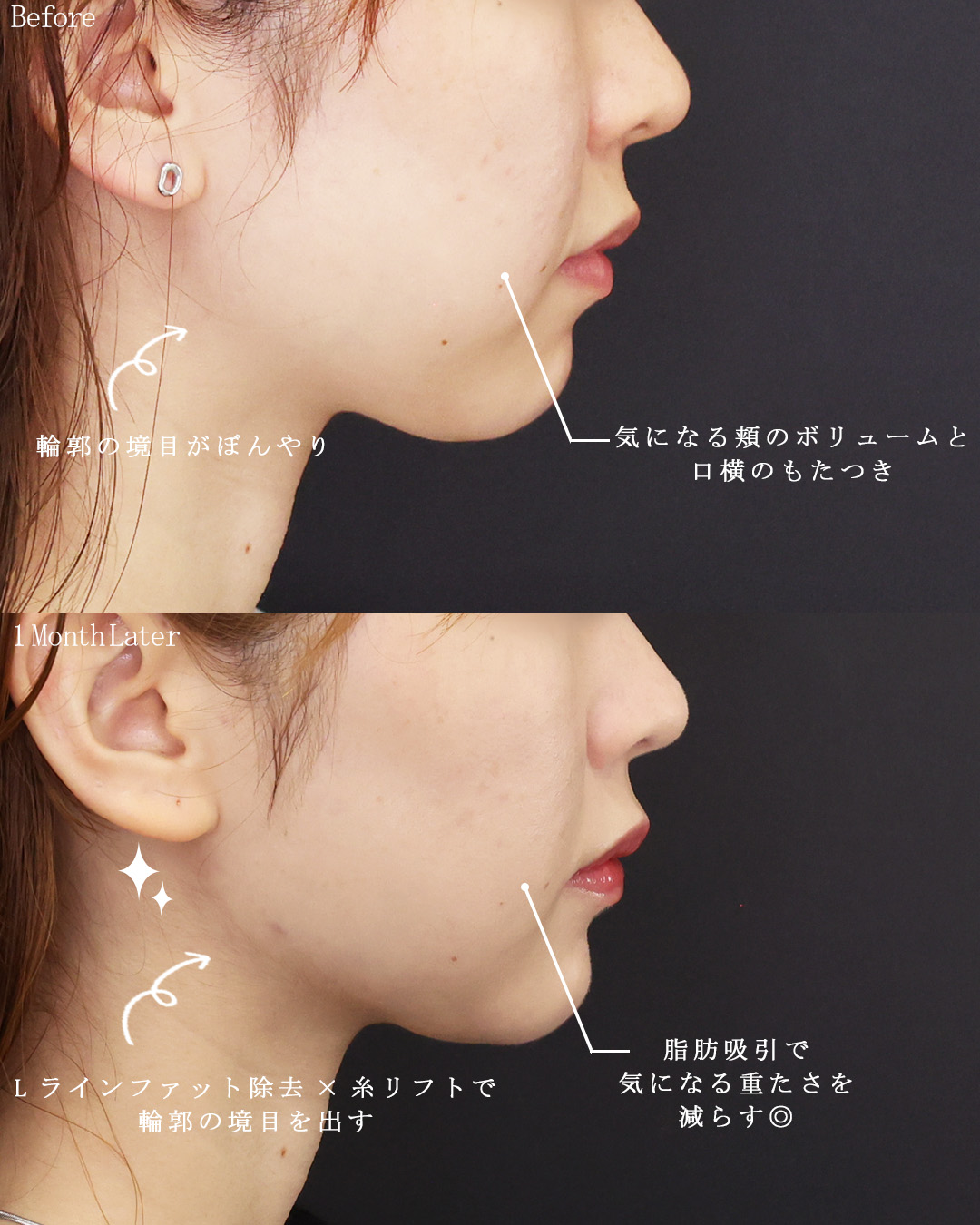 TAC式 ツヤ肌コラーゲンリフト®/Lラインファット除去（エラ下脂肪除去）/ジョールファット除去の症例写真 施術前後 