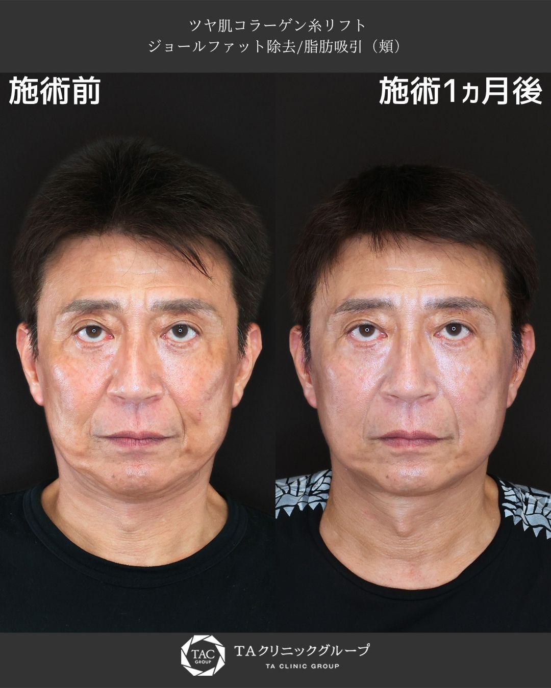 重たさをそぎ落として、自然に若返る。清潔感あるフェイスラインへ