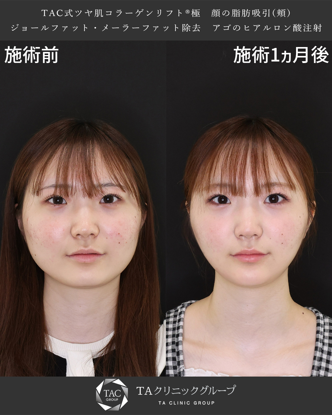 【Dr.森】四角い顔も美しい卵型輪郭に！【小顔脂肪吸引】