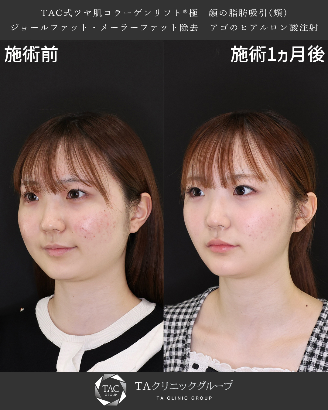 TAC式 ツヤ肌コラーゲンリフト®/顔の脂肪吸引/顎のヒアルロン酸注射の症例写真 施術前後 