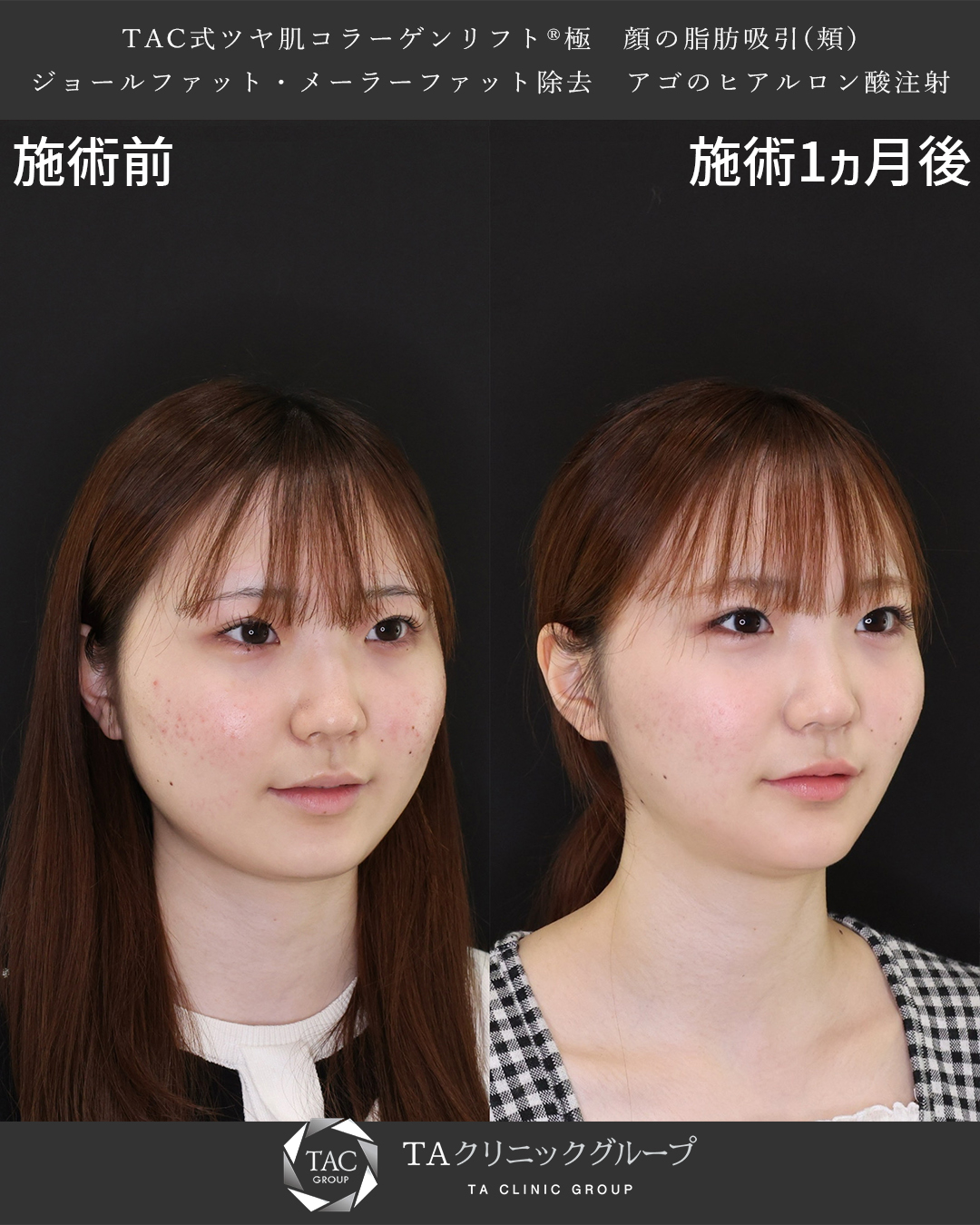 TAC式 ツヤ肌コラーゲンリフト®/顔の脂肪吸引/顎のヒアルロン酸注射の症例写真 施術前後 