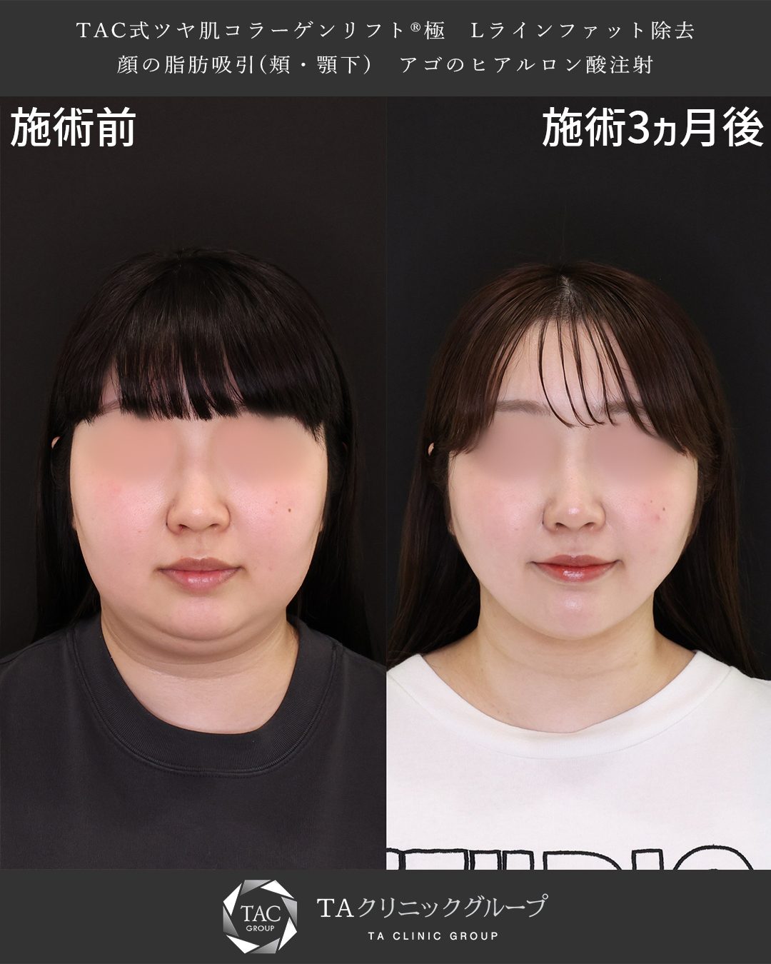 【Dr.森】二重顎解消！顔と首の境がクッキリ【小顔脂肪吸引】