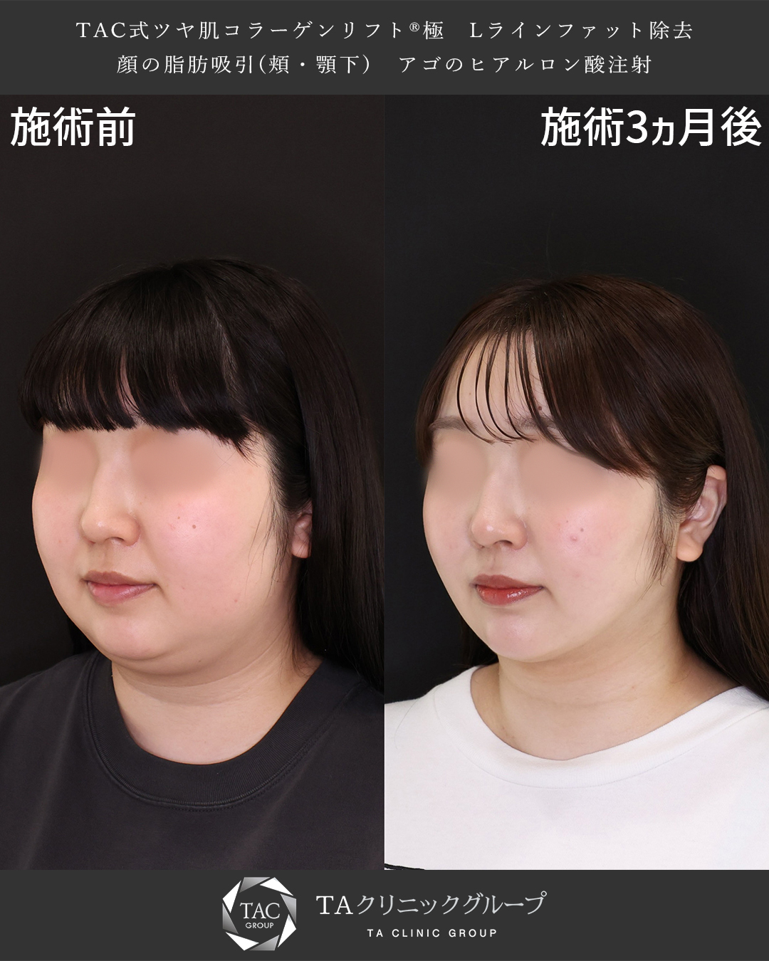 TAC式 ツヤ肌コラーゲンリフト®/顔の脂肪吸引/Lラインファット除去（エラ下脂肪除去）の症例写真 施術前後 