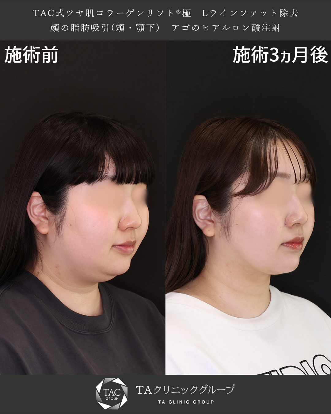 TAC式 ツヤ肌コラーゲンリフト®/顔の脂肪吸引/Lラインファット除去（エラ下脂肪除去）の症例写真 施術前後 