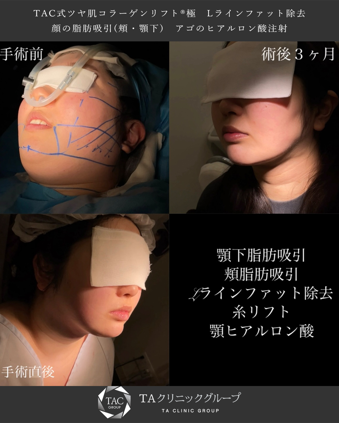 TAC式 ツヤ肌コラーゲンリフト®/顔の脂肪吸引/Lラインファット除去（エラ下脂肪除去）の症例写真 施術前後 