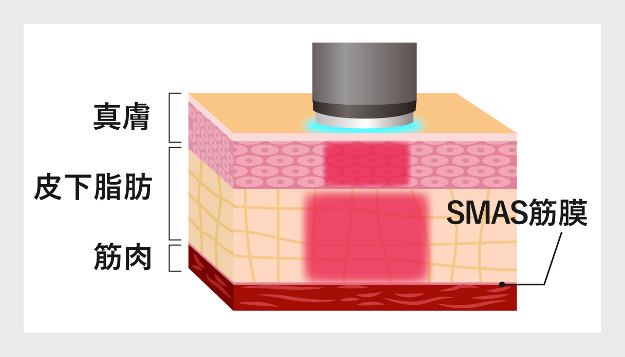 オンダリフト・オンダリフトボディとは