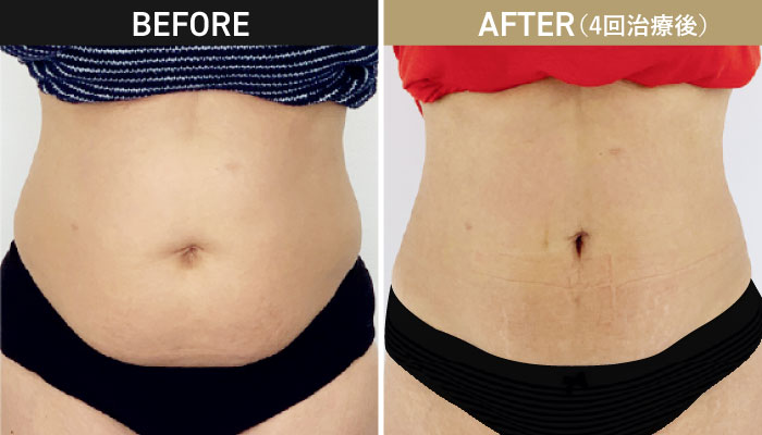 オンダリフトボディ施術症例写真