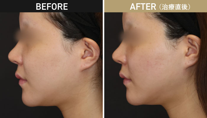 オンダリフト施術前後症例写真1