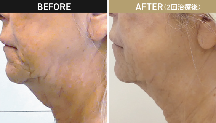 オンダリフト施術前後症例写真2