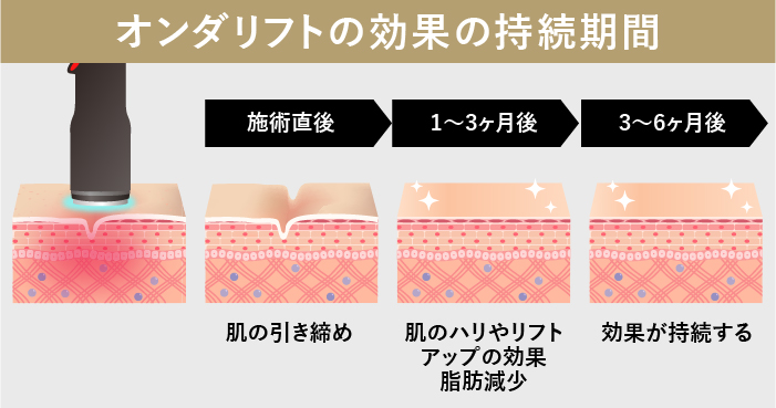 オンダリフトの効果発現と持続期間のイメージ
