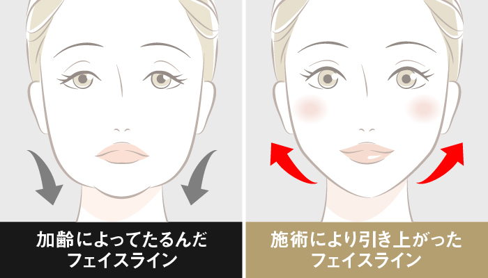 フェイスラインの引き上げと引き締め効果