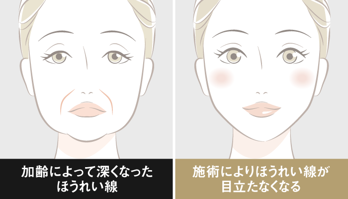 中顔面の改善（ほうれい線・口元）